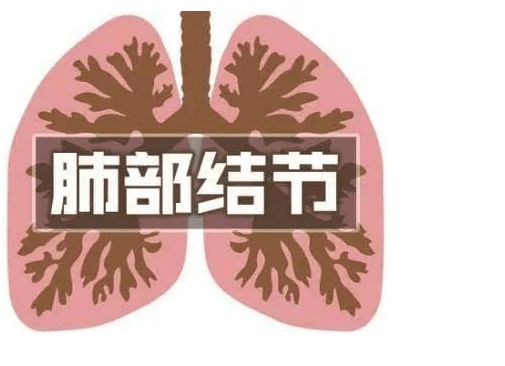 肺结节是怎么回事严重吗 看中医肿瘤专家怎么说